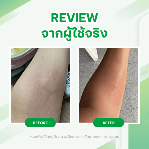 นวัตกรรมครีมสารสกัดจากธรรมชาติ สําหรับผื่นแพ้คัน และแมลงสัตว์กัดต่อย